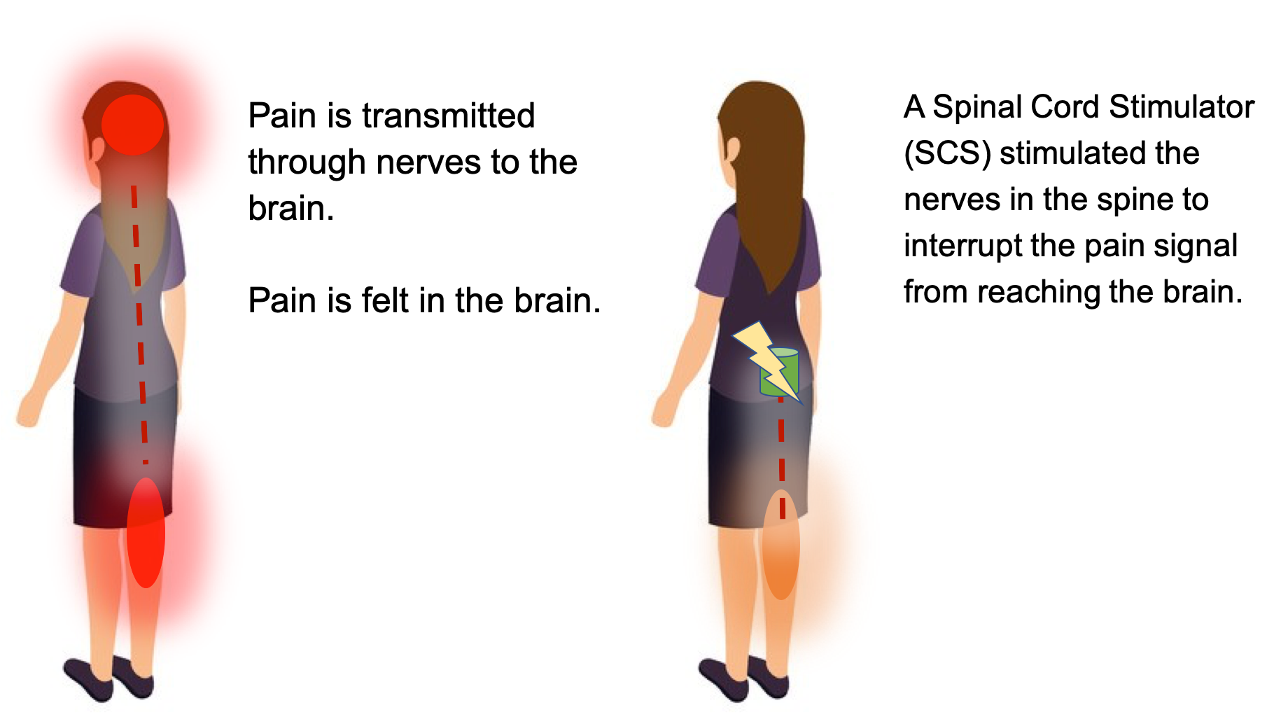 What is Spinal Cord Stimulation (SCS)?